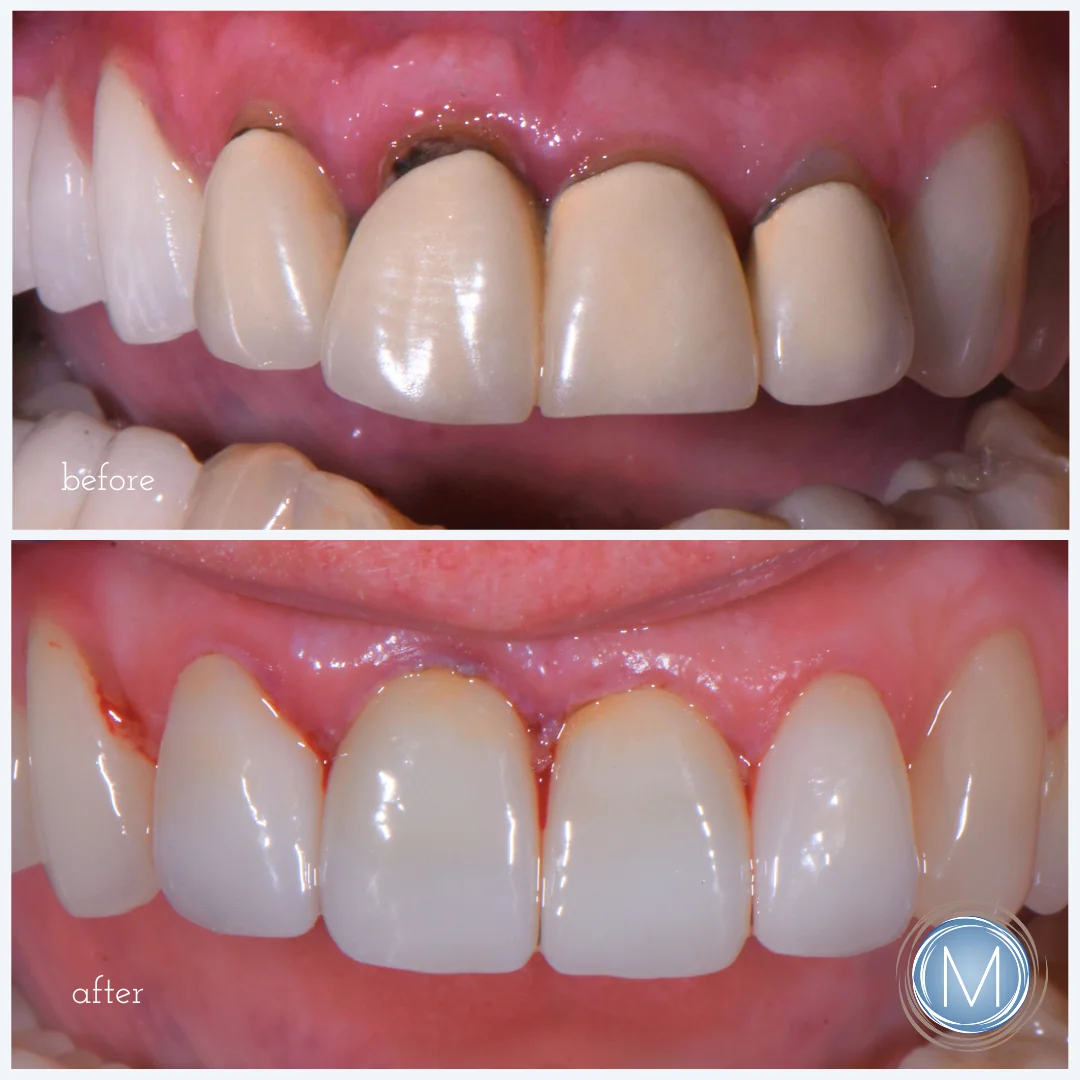 Before and after dental treatment at Markiewicz Dental, Mundelein
