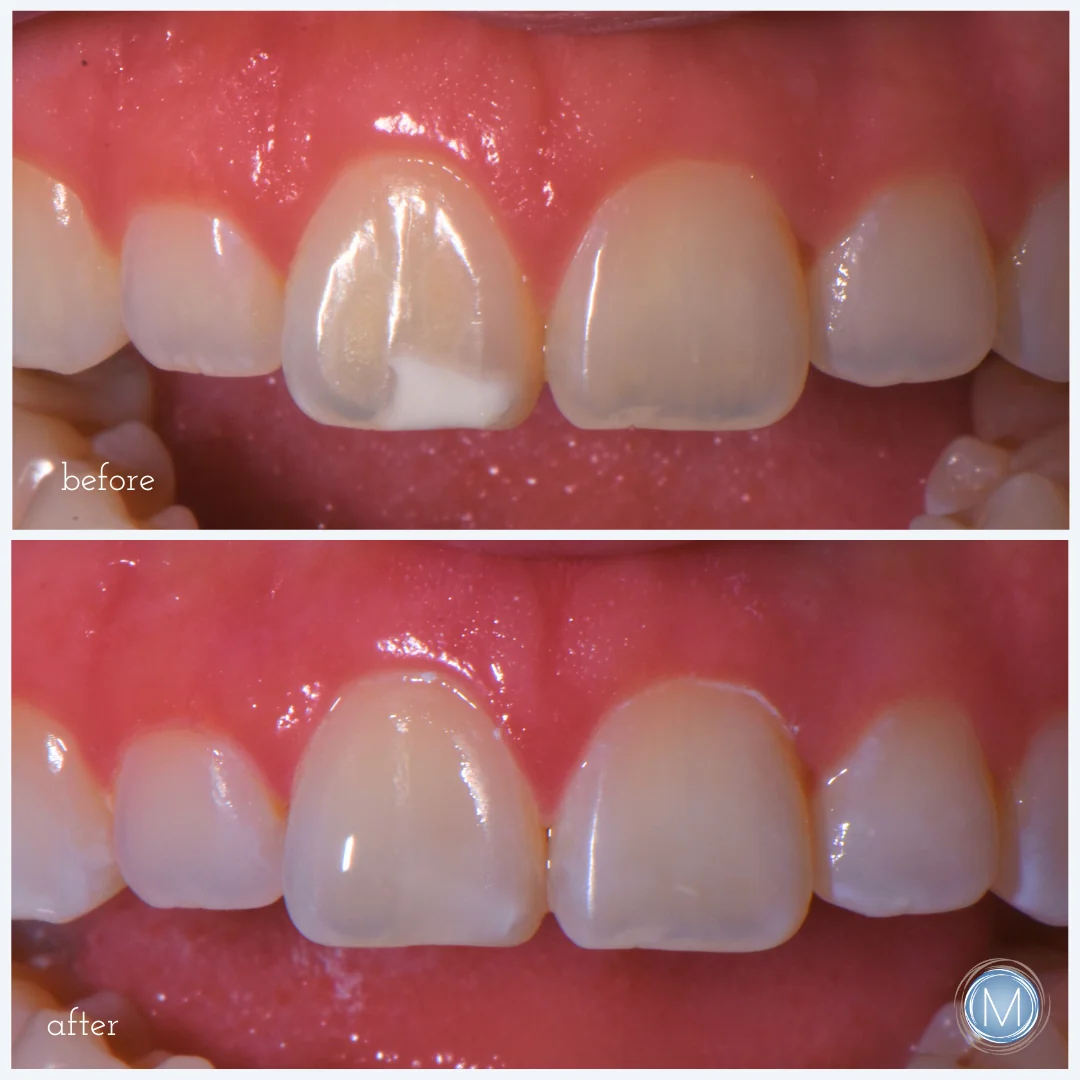 Before and after dental treatment at Markiewicz Dental, Mundelein